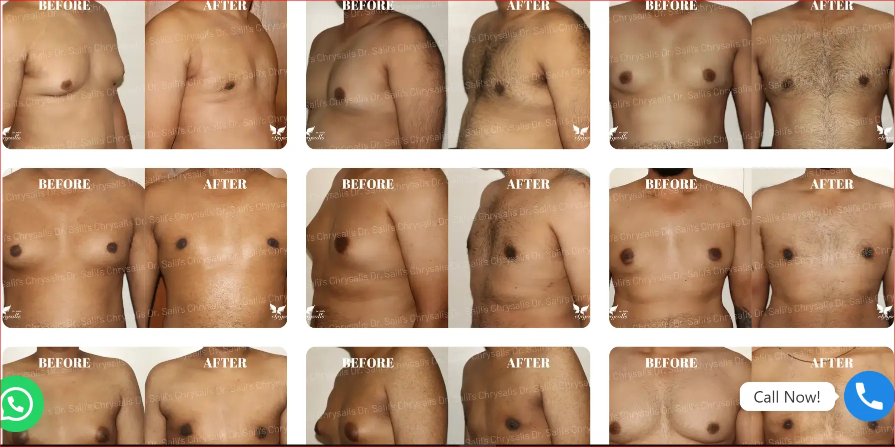 Before and after gynecomestia